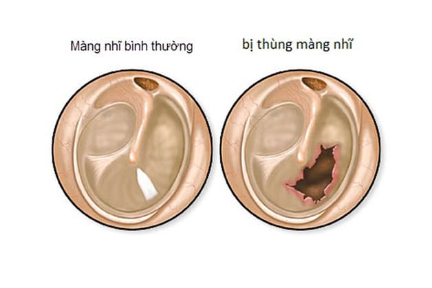 Thủng màng nhĩ, nguyên nhân do đâu?