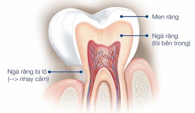Răng nhạy cảm là cách gọi phổ biến của hiện tượng quá cảm ngà, hay còn gọi là triệu chứng ê buốt chân răng.