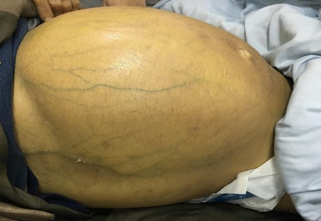 triệu chứng của xơ gan mất bù