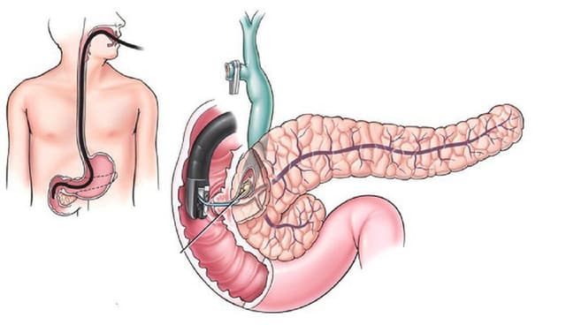 Người mắc ung thư tụy kiêng ăn gì?