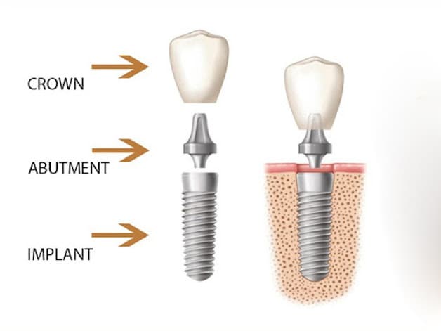 Cấy ghép implant là một phương pháp giúp khắc phục tình trạng mất răng.