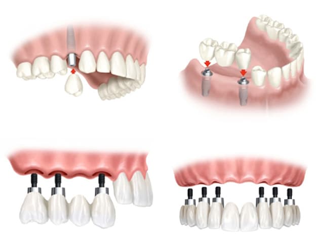 Implant có thể áp dụng với nhiều trường hợp: Mất một răng, nhiều răng hoặc thậm chí cả hàm.