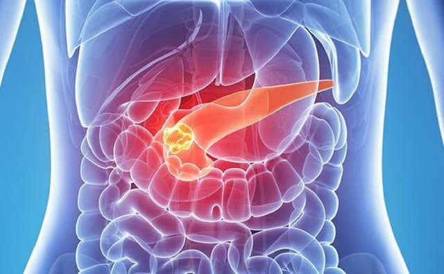 Lý giải vì sao bị ung thư tụy và những dấu hiệu sớm của bệnh