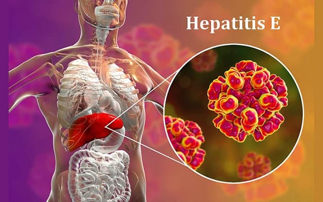 Viêm gan E là do virus HEV gây ra và lan truyền