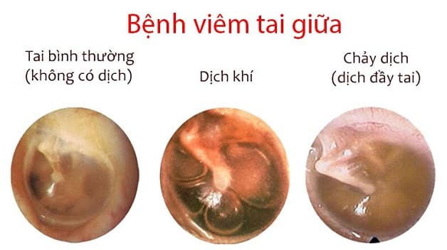 Viêm tai giữa trẻ sơ sinh là hiện tượng tai bị vi khuẩn, virus tấn công gây nhiễm trùng, xuất hiện nhiều dịch ở tai