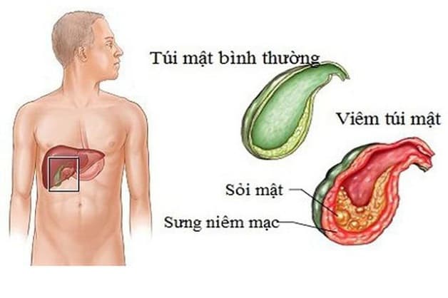Viêm túi mật hoại tử liên quan chủ yếu đến sỏi mật hoặc giun chui ống mật
