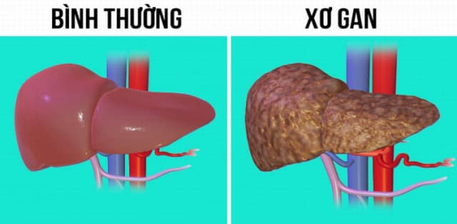 Xơ gan độ 3 sống được bao lâu? Giải đáp từ chuyên gia
