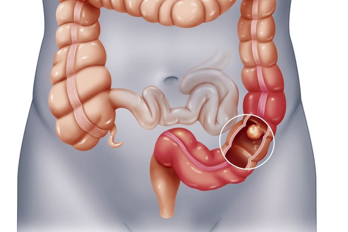 Bán tắc ruột là gì? 3 điều cần biết về tắc ruột