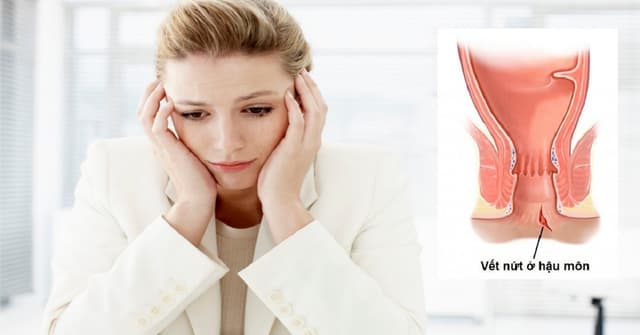 [Giải đáp thắc mắc] Bị nứt kẽ hậu môn phải làm sao?