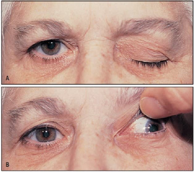 biểu hiện viêm ở dây thần kinh số 3