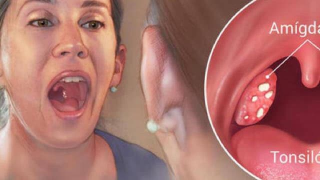 Cắt amidan hốc mủ và những điều cần biết