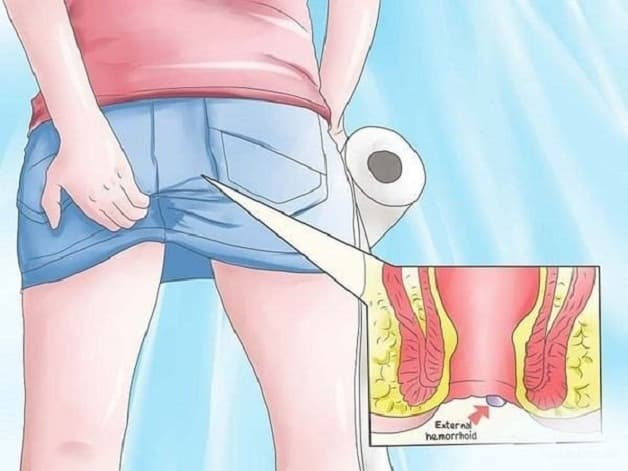 Phẫu thuật cắt trĩ chỉ định cho người mắc trĩ cấp độ 3 trở lên