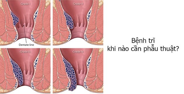 Cắt trĩ phương pháp mới áp dụng cho trường hợp trĩ ở cấp độ nặng