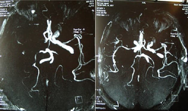 chụp MRI mạch máu não giúp xác định thiếu máu não có chữa được không