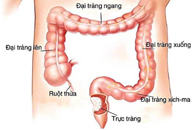 Đại trực tràng là gì