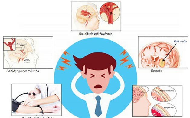 Stress chỉ là một trong những nguyên nhân duy nhất gây đau đầu kéo dài