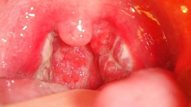 hình ảnh áp xe quanh amidan