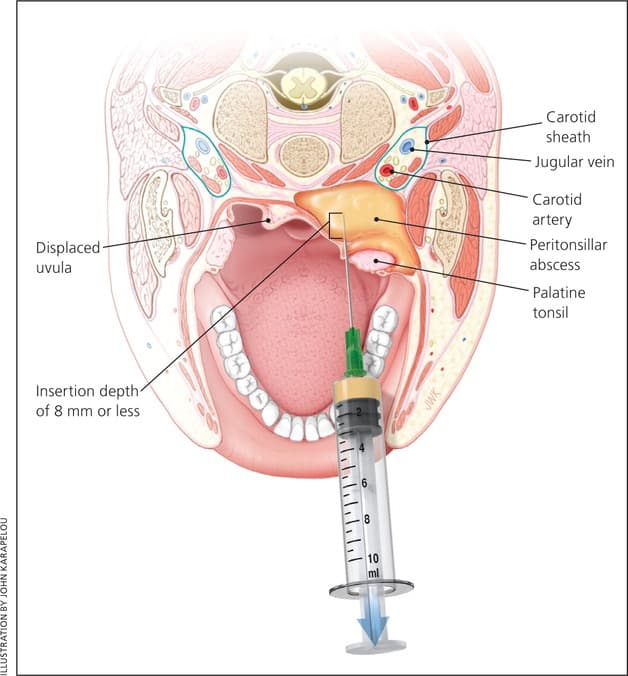 chích áp xe quanh amidan