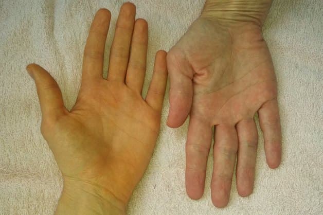 dấu hiệu nhận biết gan nhiễm mỡ 