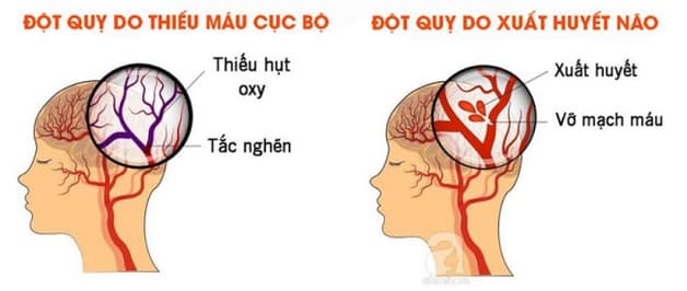 đột quỵ cấp là gì