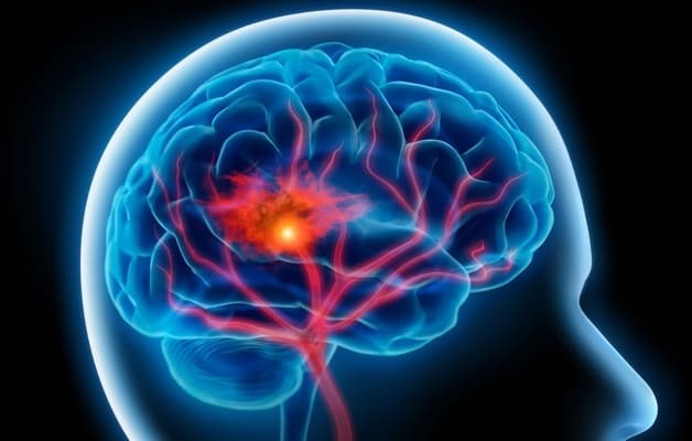 đột quỵ xảy ra ở độ tuổi nào?