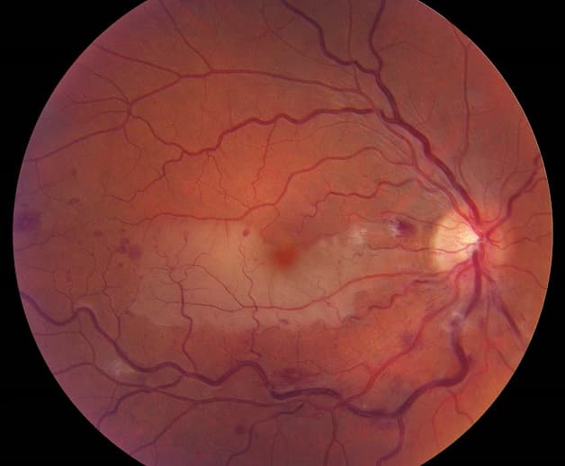 Ai có nguy cơ mắc đột quỵ vùng mắt