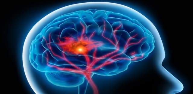 Đột quỵ xảy ra ở độ tuổi nào và làm sao để phòng ngừa?