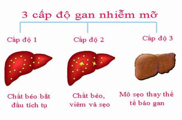 Gan nhiễm mỡ có mấy cấp độ cần biết 