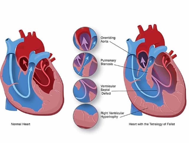 Hẹp van tim bẩm sinh: Nguyên nhân và triệu chứng 