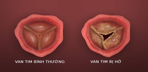 hở van động mạch chủ 1/4 là gì 