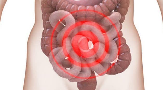 Hội chứng ruột kích thích IBS điển hình bởi triệu chứng đau bụng, tiêu chảy và táo bón