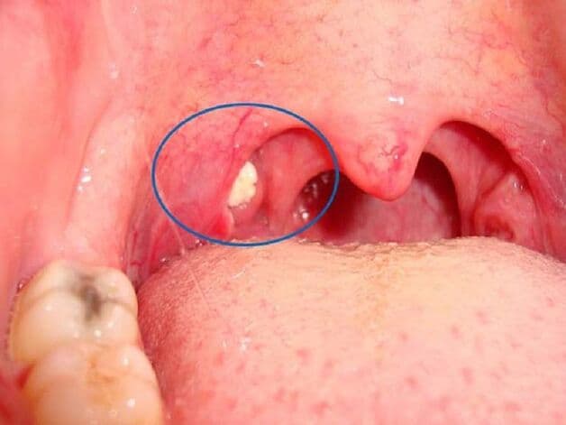 lấy sỏi amidan ở đâu