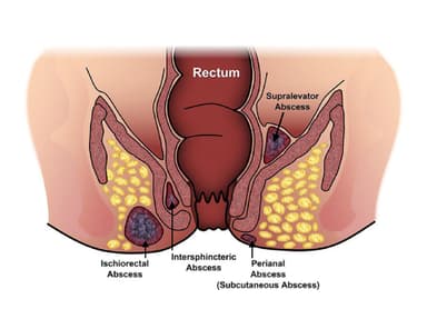 Mổ rò hậu môn &#8211; Phương pháp điều trị hiệu quả