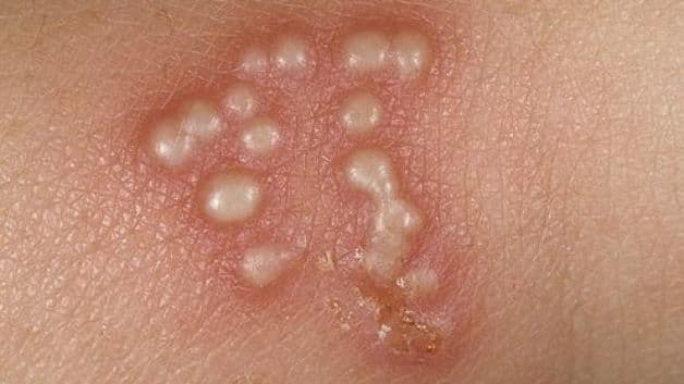 Người bệnh sẽ thấy sự xuất hiện của các nốt mụn nước tại niêm mạc vùng cơ quan sinh dục (âm đạo, bên trong âm đạo, bên trong cổ tử cung) hoặc mông, đùi, bên trong hậu môn…