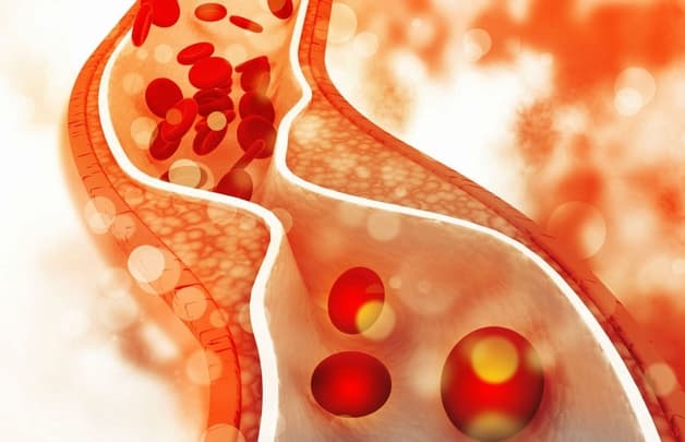 Nguyên nhân gây thiếu máu não