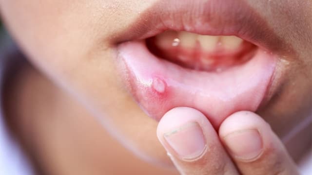 Nhiệt miệng thiếu vitamin gì và cách bổ sung hiệu quả