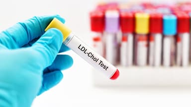 Xét nghiệm bộ mỡ và những lưu ý cần biết