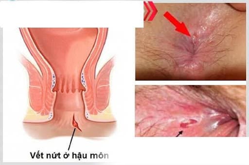 Nứt kẽ hậu môn ngâm nước muối là một hành động tốt