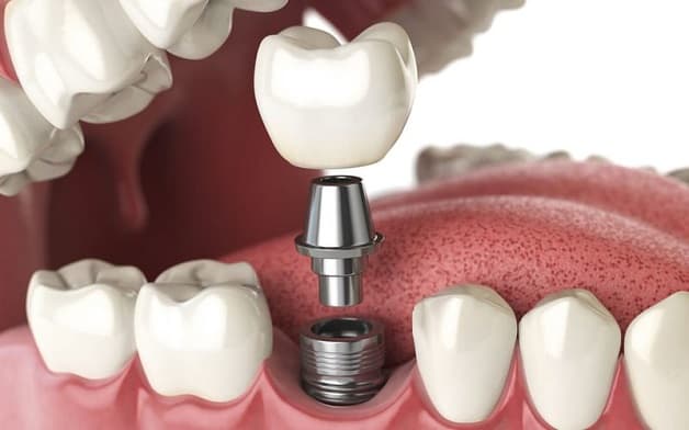 Phẫu thuật cấy ghép implant không lầm ảnh hưởng tới các răng xung quanh