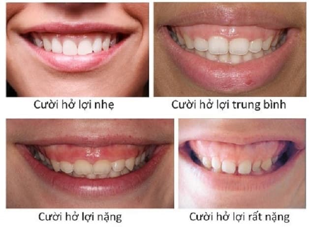 Có 4 cấp độ cười hởi lợi