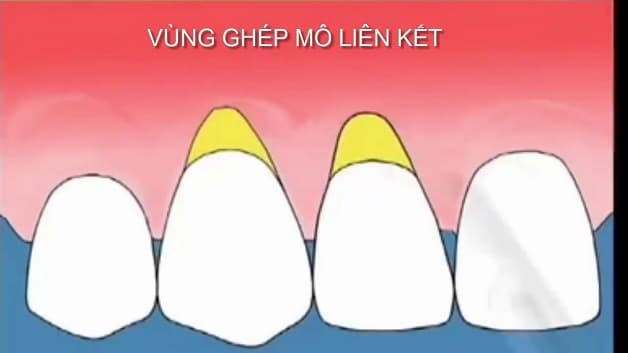 Mô phỏng phương pháp ghép mô liên kết