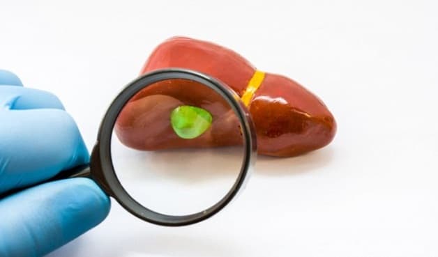 Siêu âm định kỳ để theo dõi sát sự phát triển của polyp túi mật 3mm. 