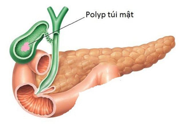 Polyp túi mật triệu chứng là gì và điều trị như thế nào?