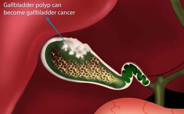 Polyp túi mật triệu chứng ở giai đoạn đầu rất thầm lặng. 