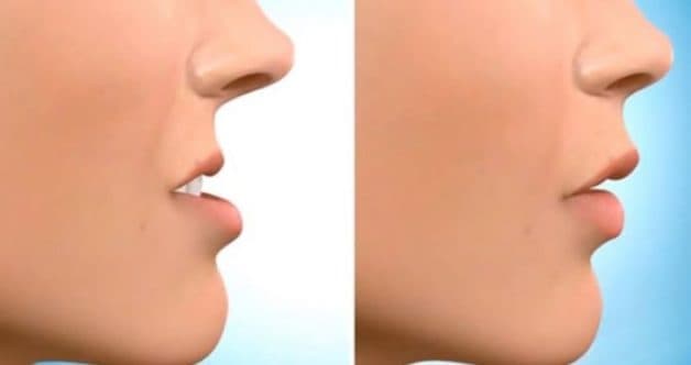 Bị móm là một trong những khuyết điểm về răng có thể chỉnh hình lại hiệu quả nhờ phương pháp 3D Clear