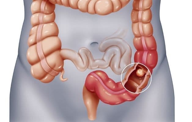 Tắc ruột cơ năng chiếm tỷ lệ nhỏ hơn nhiều so với tắc ruột cơ học