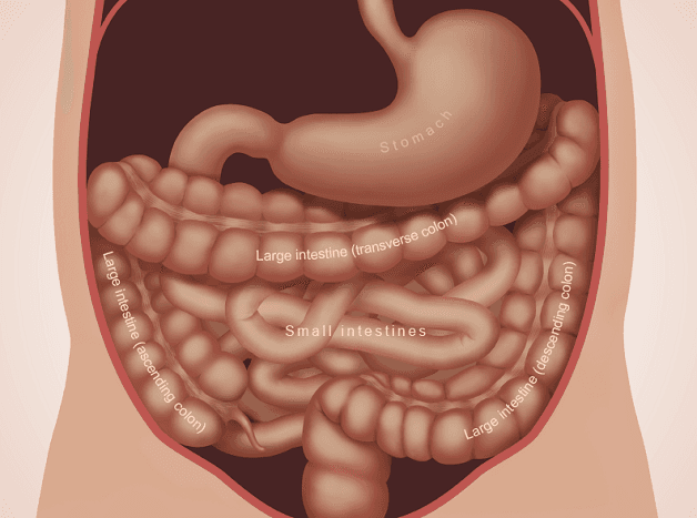 Tắc ruột ở trẻ sơ sinh