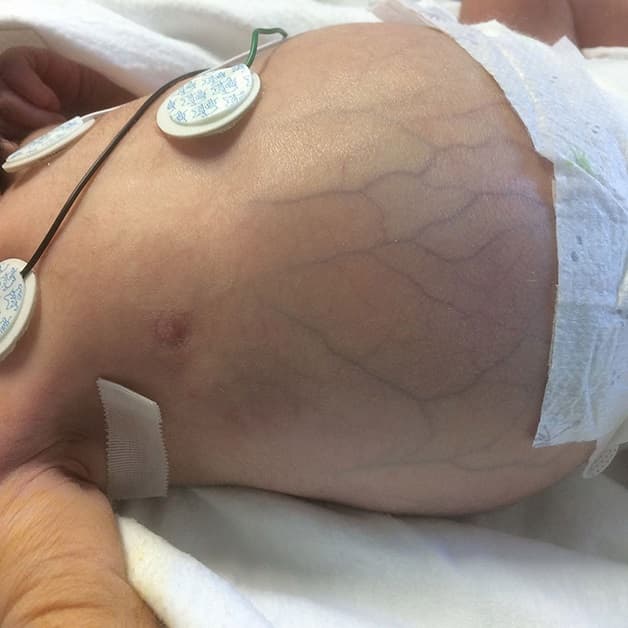 Bụng chướng và tuần hoàn bàng hệ trong tắc ruột ở trẻ sơ sinh