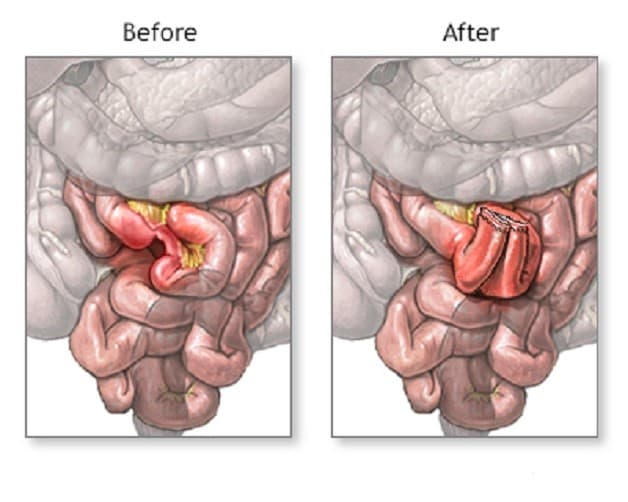 Điều trị tắc ruột ở trẻ sơ sinh