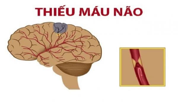 thiếu máu não triệu chứng là gì?